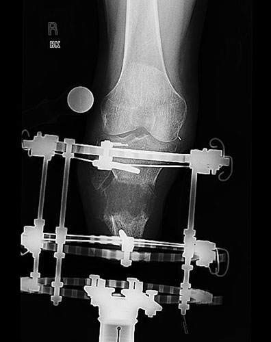 X-ray of tibia new bone growth