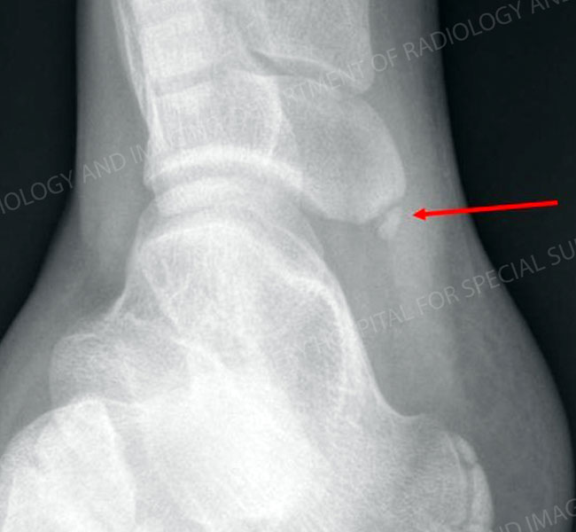 Enlarged view of the affected area in accessory navicular.