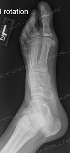 X-Ray image of the left foot with an Accessory navicular from an article about pediatric foot deformities
