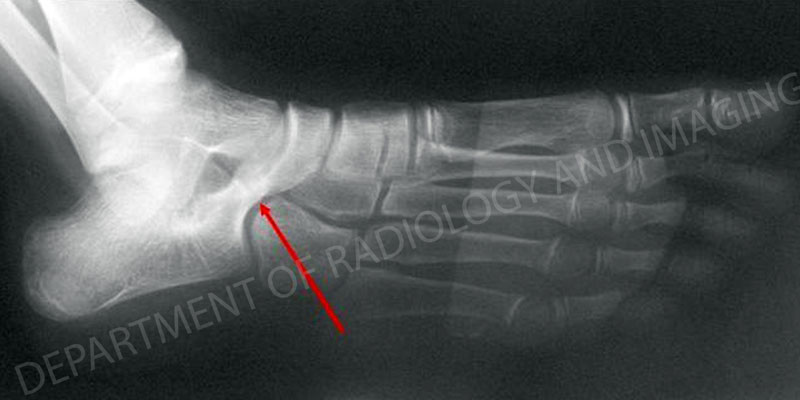 Right foot demonstrating Calcaneonavicular Coalition - The red arrow indicates the coalition from an article about pediatric foot deformities