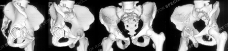3 dimensional CT reconstructions