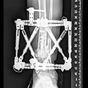 Image: Reconstruction of Bone Defects After Malignant Tumor Resection