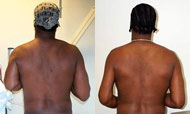 Before and after photo of humerus lengthening