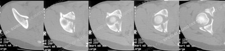CT scans images delineate the fracture pattern from a case example presented by the orthopedic trauma service at Hospital for Special Surgery.