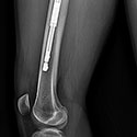 Femur Lengthening with Precice Internal Lengthening Nail
