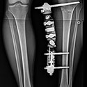 Correction of bilateral Genu Varum for a high level athlete