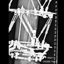 Distal Tibial Bone Defect Treated with Bone Transport Using Two Proximal Osteotomy Sites