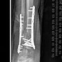 limb lengthening academic case