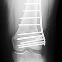 Correction of Varus Deformity of the Femur and Tibia in Patient with LCL Laxity