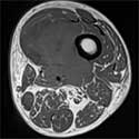 Bone cancer image