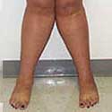 bowleg knock knee leg image
