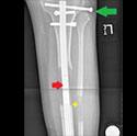 Image: Tibia Lengthening with PRECICE Internal Lengthening Nail