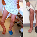 Trauma: Nonunion and Malunion