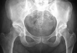 Before photo of Bilateral total hip replacement