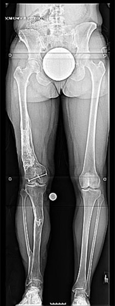 Before photo of Tibia lengthening with the LATN technique