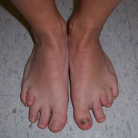 Before photo of Bilateral metatarsal lengthening and tibial deformity corrections