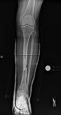 Before photo of Bone transport and then nailing of the tibia