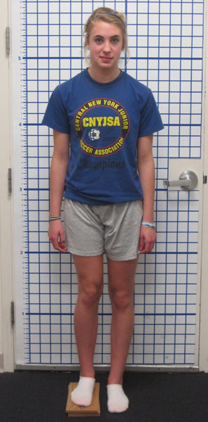 Before photo of Femur lengthening and deformity correction after growth arrest