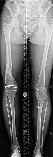 Before photo of Femur lengthening and deformity correction