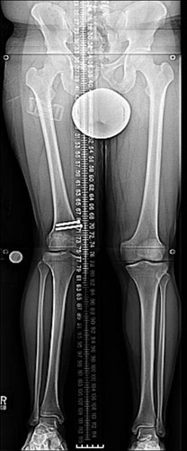 Before photo of Femoral Reconstruction in a Soccer Player