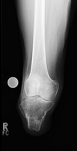 X-ray of leg
