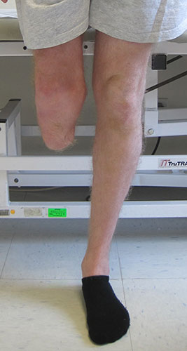 Amputee from knee down