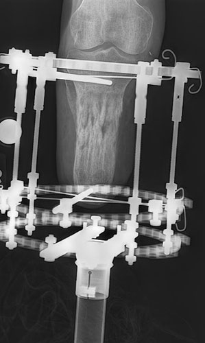 X-ray of tbia new bone growth 2 months later