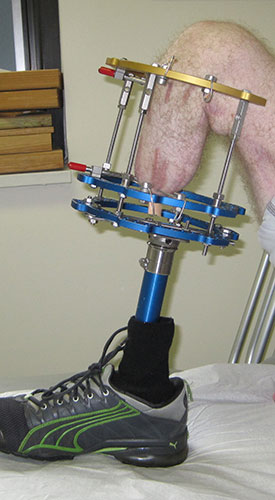 Bent Leg with external fixator