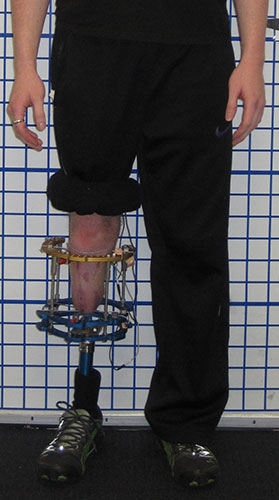 Patient standing  with external fixator and prosthesis