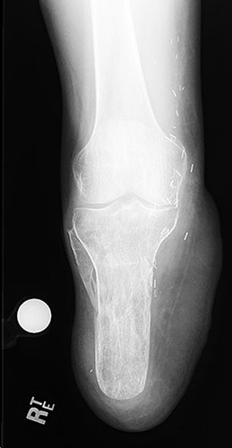 X-ray of healed bone