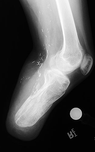 X-ray of healed bone