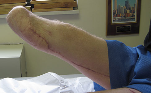 Clincial photo of length of residual limb of leg
