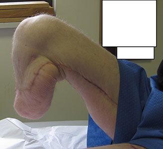 Clincial photo of length of residual limb of leg bent