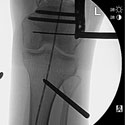 Image: Correction of Windswept Rotational Deformity