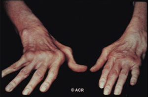 image of joint damage