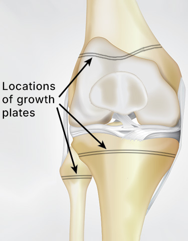 Illustration of growth plate locations in the bones of a child's knee.