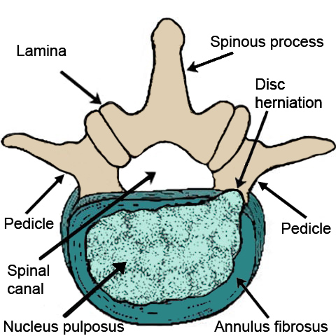 Illustration of a lumbar spine vertebra with a disc herniation.
