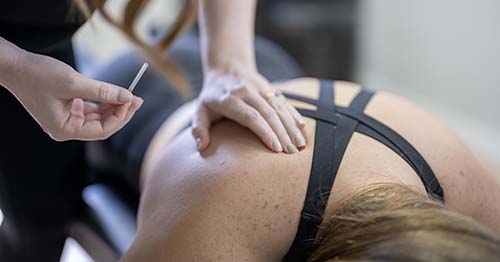 Stephanie Cheng, MD, performing acupuncture.