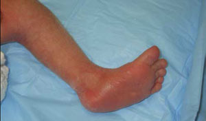 After the first cast, the foot is straight and the cavus and crease are no longer evident.