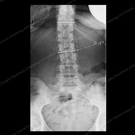 X-ray showing degenerative scoliosis in its first stages 