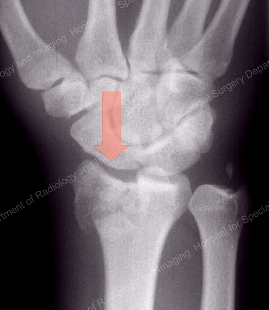 X-ray image showing a compression fracture of the distal radius