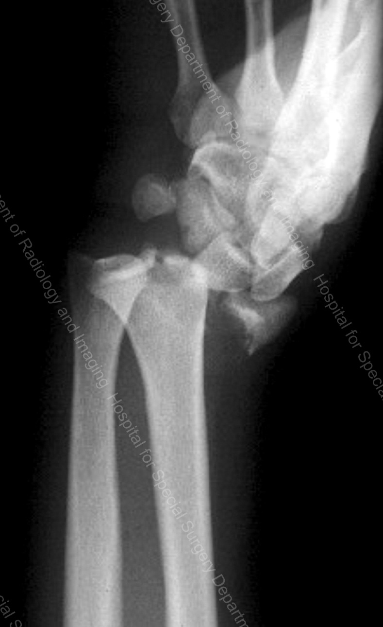 X-ray of a distal radius fracture