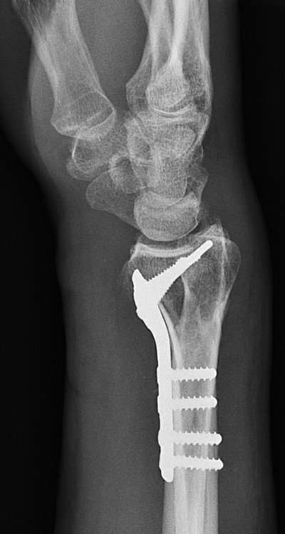 Volgar angular stable fixation for surgical treatment of a distal radius fracture.