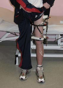 Photo of an external fixation ("ex-fix") device worn by a patient. 
