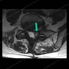 MRI of a patient with a facet cyst causing compression of nerves