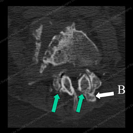CT scan showing abnormal, osteoarthritic facet joints with thinned and irregular joint