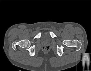 CT scan showing bony anatomy and alignment