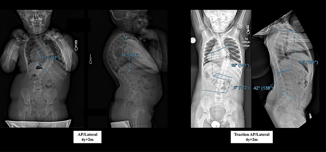 Oct complex case - Anteroposterior (AP) radiographs demonstrating scoliosis
