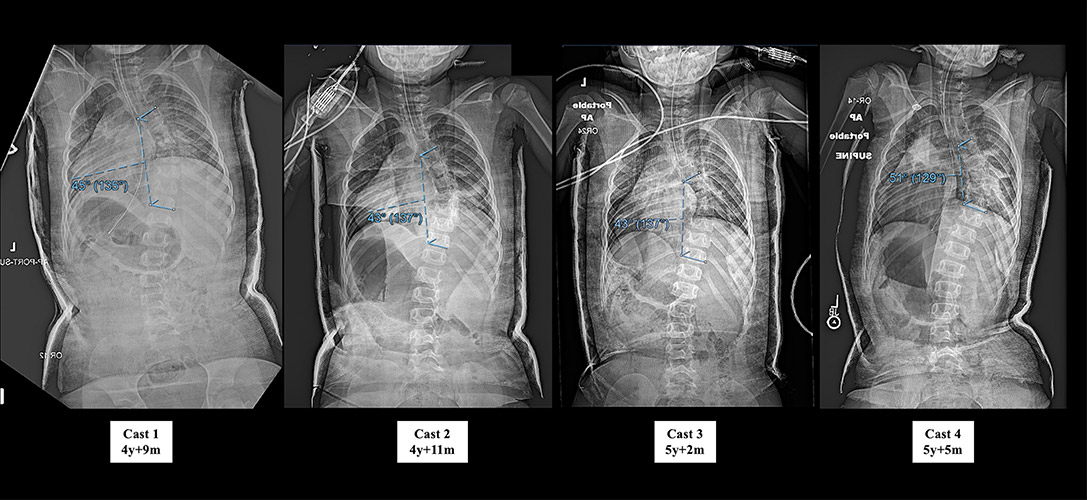 Figure 2 - Mehta casting series of AP radiographs over an 8-month period