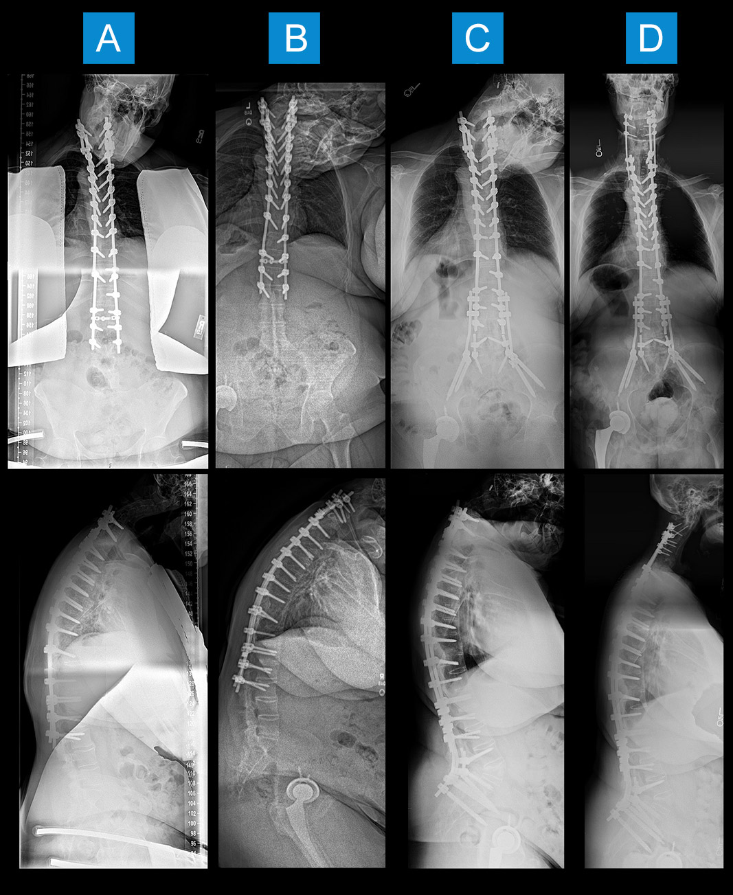 Sept complex case - full length standing anteroposterior and lateral radiograph images of spine